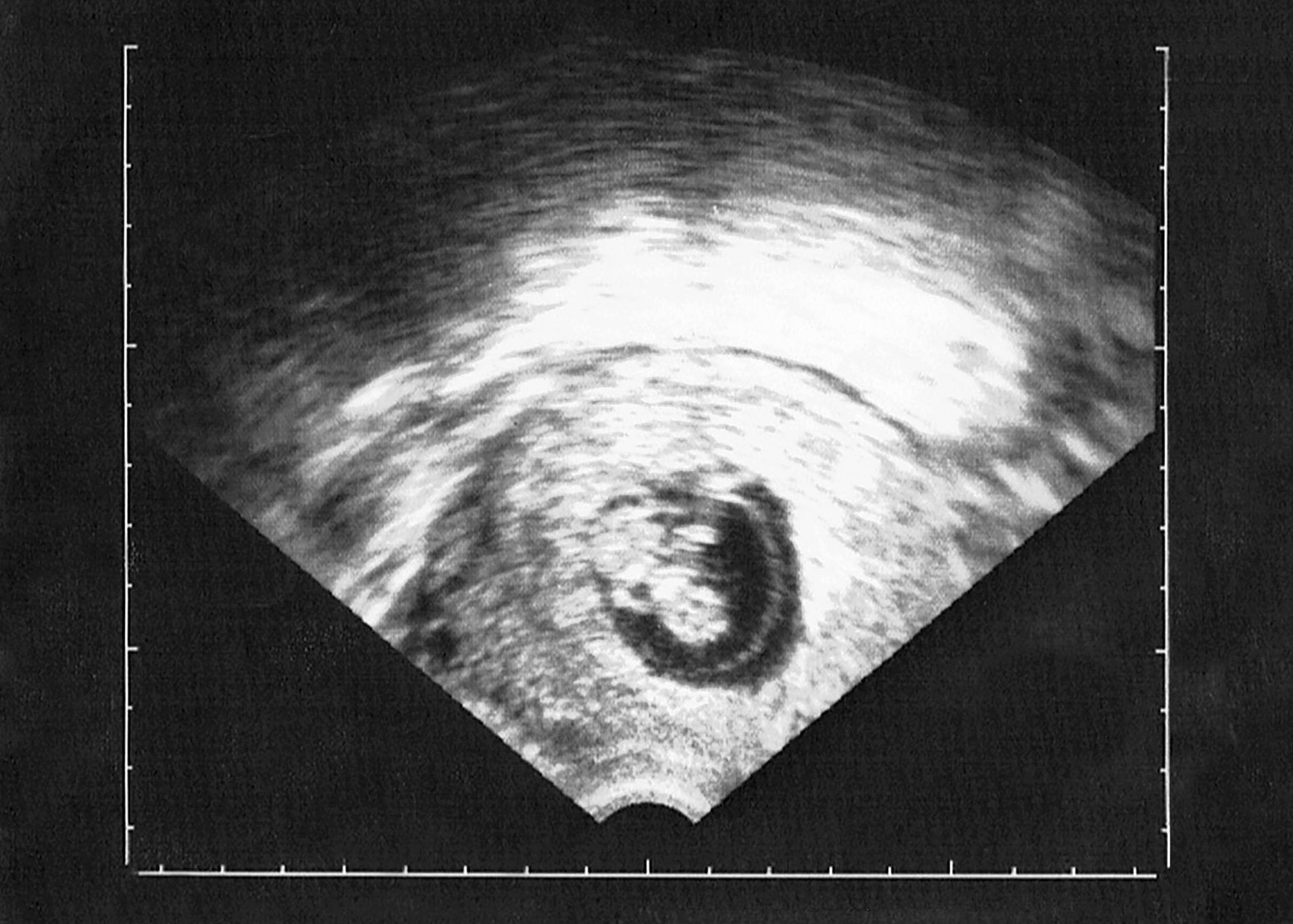 Scan eines Ultraschalls einer Schwangerschaft